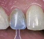 fácil y segura. 1. Situación inicial: dientes decolorados, caries extensa, malposición, alineación axial incorrecta.