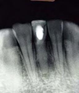Exámen Radiográfico Salud Oral Sin Reabsorción ósea Se observa diente con apertura coronaria y