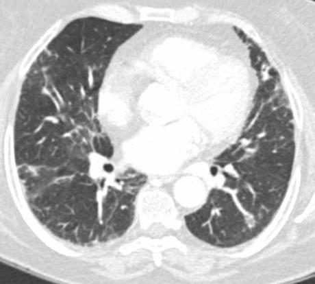 Lesiones pulmonares