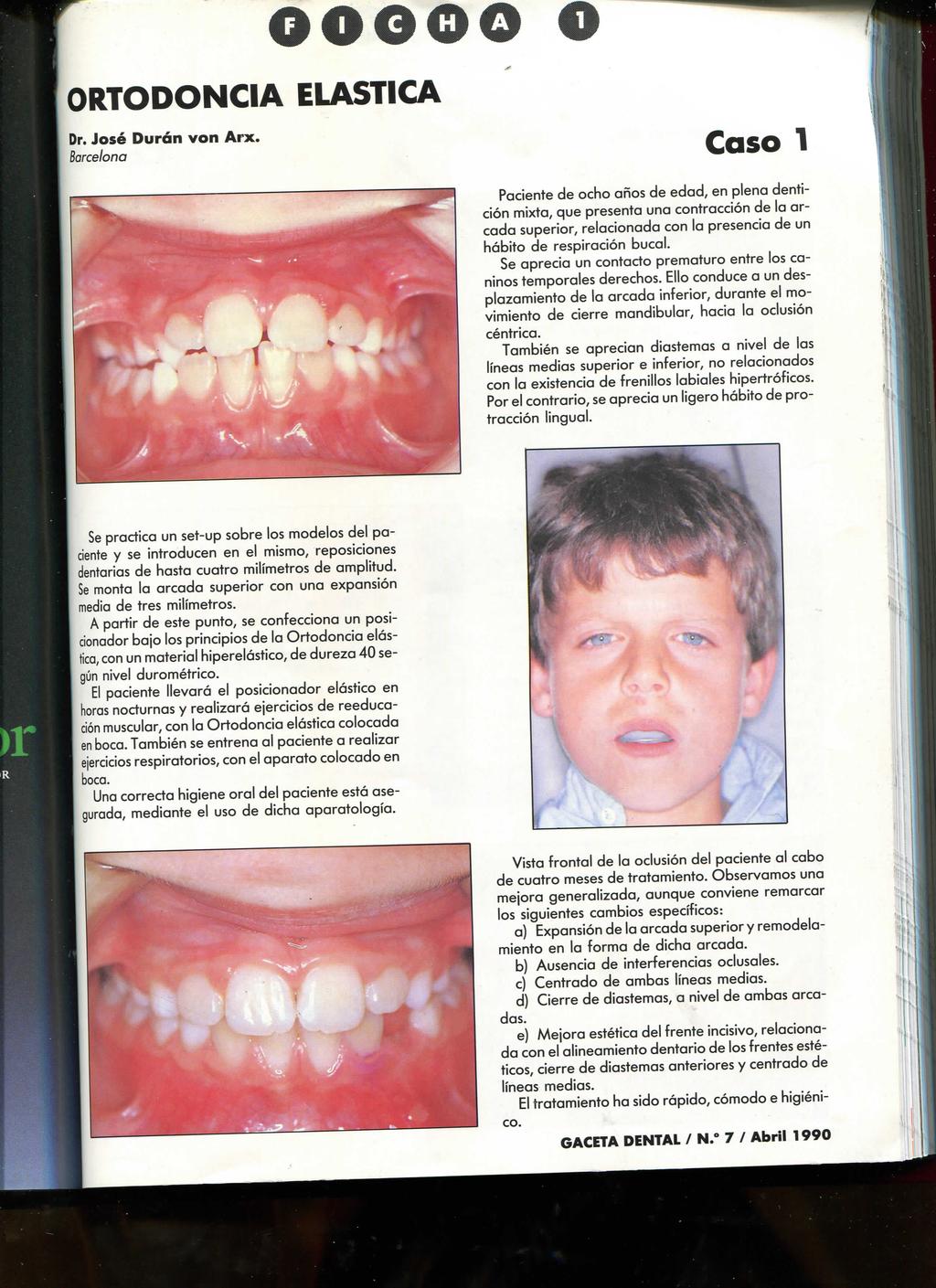 Caso 1 Paciente de ocho años de edad, en plena dentición mixta, que presenta una contracción de lo arcada superior, relacionado con la presencia de un hábito de respiración bucal.