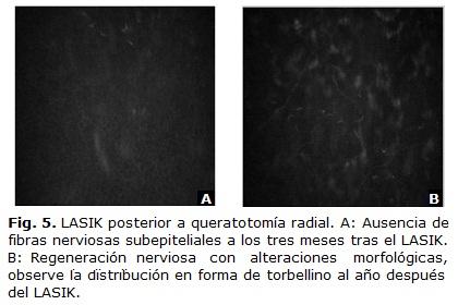 Se pudo describir una distribución en forma de remolinos o torbellinos (Fig. 5). Hubo una recuperación paulatina de la sensibilidad corneal.