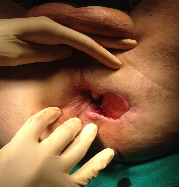extensión (TAC toraco-abdomino-pélvico) que no muestra enfermedad a distancia.