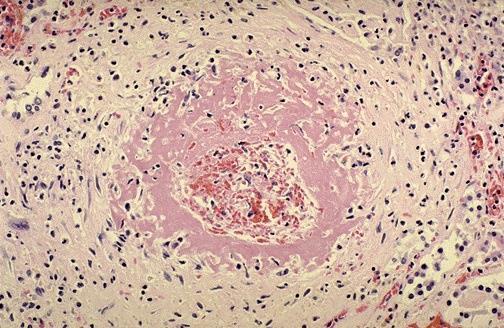 Necrosis Fibrinoide Arteriola renal con