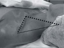 Fig 5: Límites del espacio supraclavicular; paciente en decúbito dorsal, sin almohada, cabeza ligeramente rotada hacia la derecha, borde posterior del esternocleidomastoideo, clavícula y borde