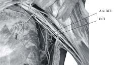 puede abarcar no solo el territorio cutáneo del mediano, sino también el del nervio radial Se anastomosa con el nervio, con el braquial cutáneo interno y con el radial por los ramos del nervio