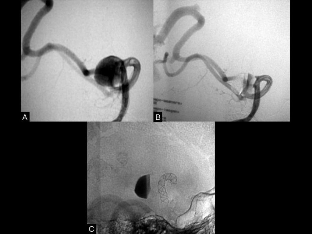 Fig. 9: A) Arteriografía selectiva de arteria vertebral derecha que muestra el relleno del saco aneurismático previo a la colocación del stent tipo Silk.