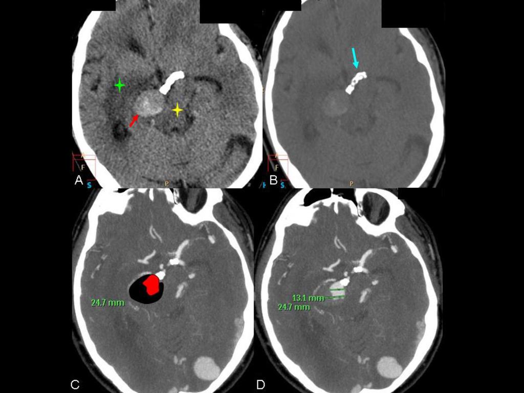 Fig. 10: TC y angio-tc cerebral. A) Corte axial. Saco aneurismático (flecha roja).