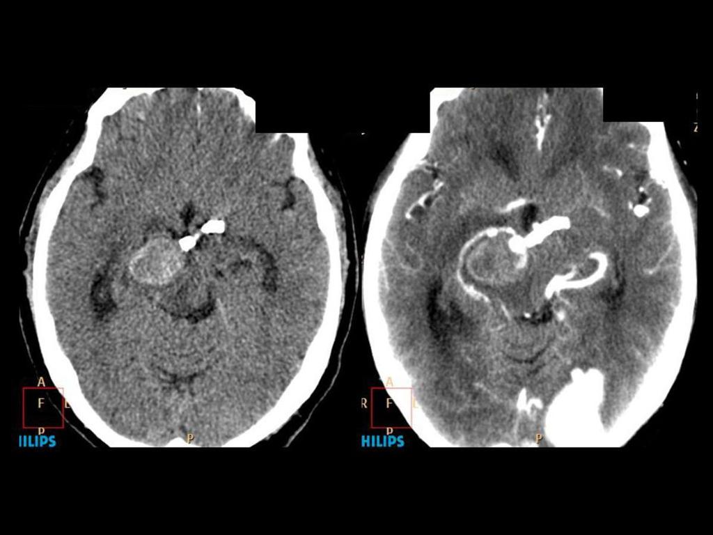 Fig. 14: TC y angio-tc cerebral de control a los 5 meses tras el tratamiento endovascular que muestra la trombosis prácticamente