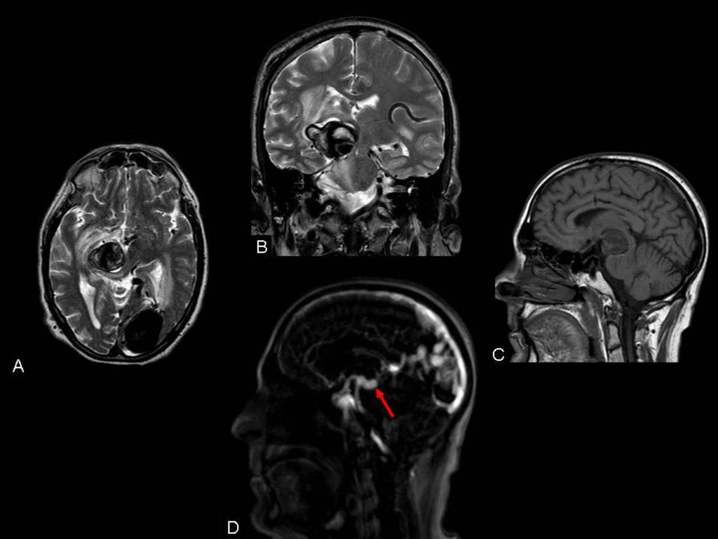 Fig. 23: RM cerebral realizada a los 9 meses tras el tratamiento endovascular y a los 5 meses tras el cuadro clínico neurológico agudo. A y B) Secuencias T2 axial y coronal.