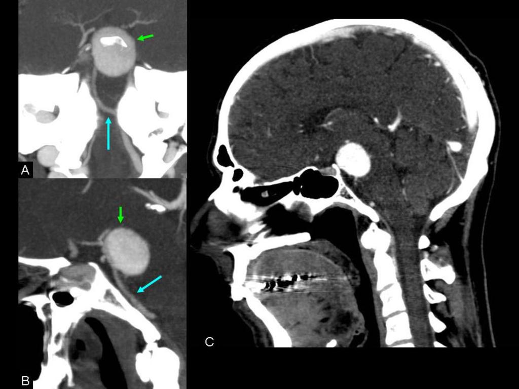 Fig. 27: Angio-TC cerebral. Se aprecia como el aneurisma (flecha verde) se encuentra en el segmento más distal de la arteria basilar (flecha azul).