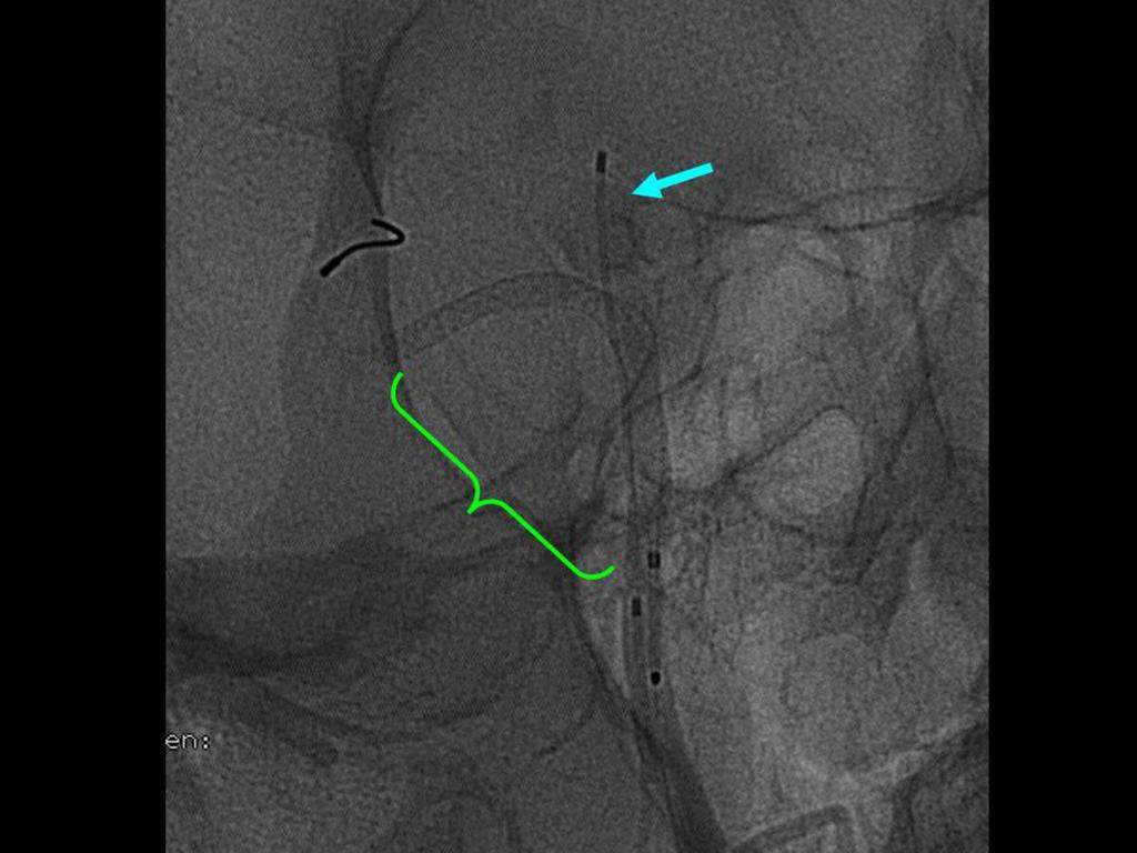Fig. 30: Imagen tomada durante el procedimiento intervencionista endovascular donde se aprecia el stent "flow diverter" tipo Pipeline abierto entre el segmento distal de la