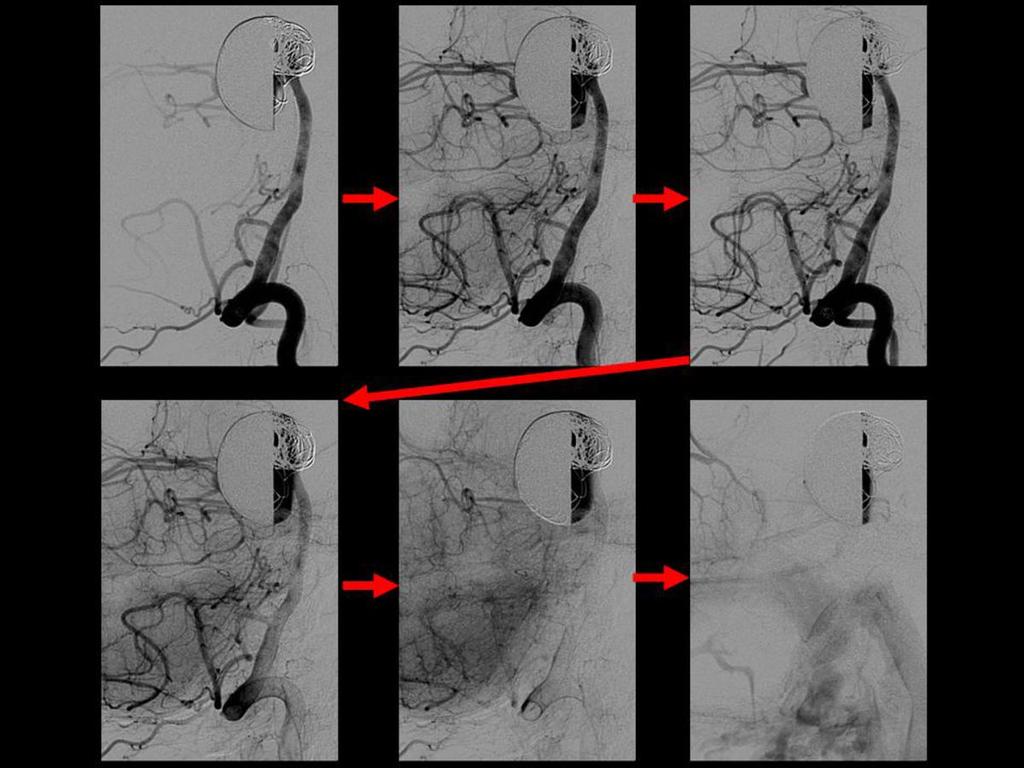 Fig. 33: Arteriografía cerebral tras la colocación de stent diversor de flujo y coils en el aneurisma gigante del top de la arteria basilar.