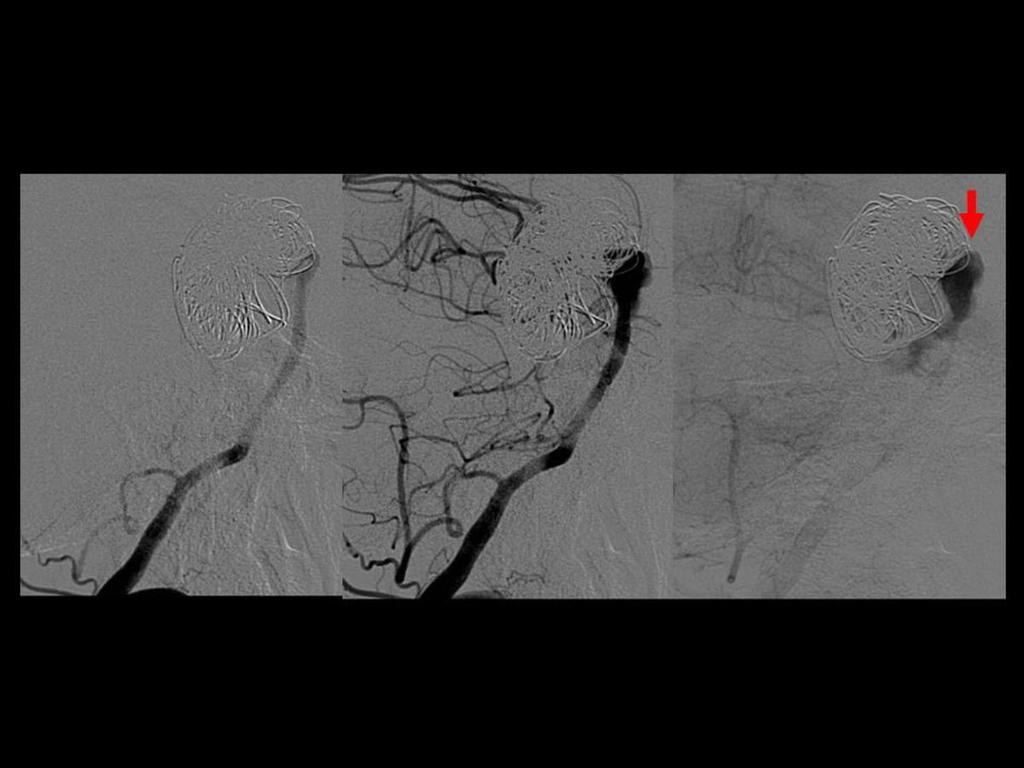 Fig. 37: Arteriografía selectiva a través de la arteria vertebral izquierda realizada a los 4 meses tras el tratamiento endovascular.