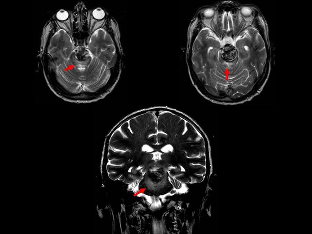 Fig. 39: RM cerebral realizada a los 4 meses del tratamiento endovascular.