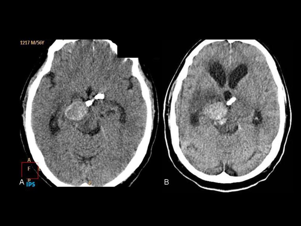 Fig. 17: A) TC cerebral realizado a los 5 meses tras el tratamiento endovascular. B) TC cerebral de urgencia realizado 10 días después de A.