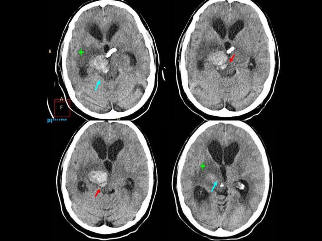 Fig. 18: TC cerebral de urgencia. Se objetiva una irregularidad de nueva aparición en la vertiente posterior del saco aneurismático (flecha roja) sugestiva de rotura contenida.