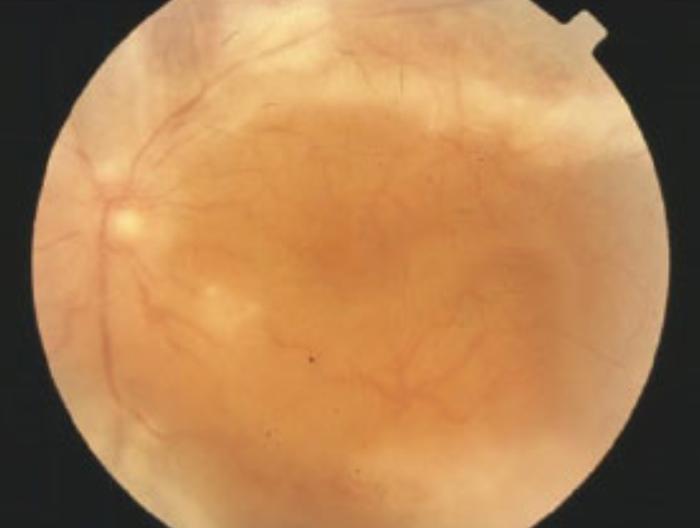 Indicación de punción lumbar En todo paciente con sífilis y síntomas neurológicos, oftalmológicos (uveítis, retinitis) u otológicos En pacientes cuya respuesta serológica después de un tratamiento