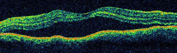 Tomográficamente aumenta la hiporreflectividad en la zona de los fotorreceptores y aparecen espacios quísticos hiporreflectivos desde la capa de fibras del nervio óptico hasta la