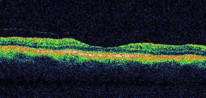 MEDISAN 2016; 20(5):662 Fig 4. Atrofia neuroepitelial. Hística y tomográficamente se aprecia el afinamiento considerable de las capas internas de la retina. Fig 5.