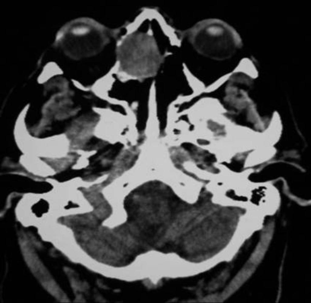 Fig. 16: TAC de cráneo.