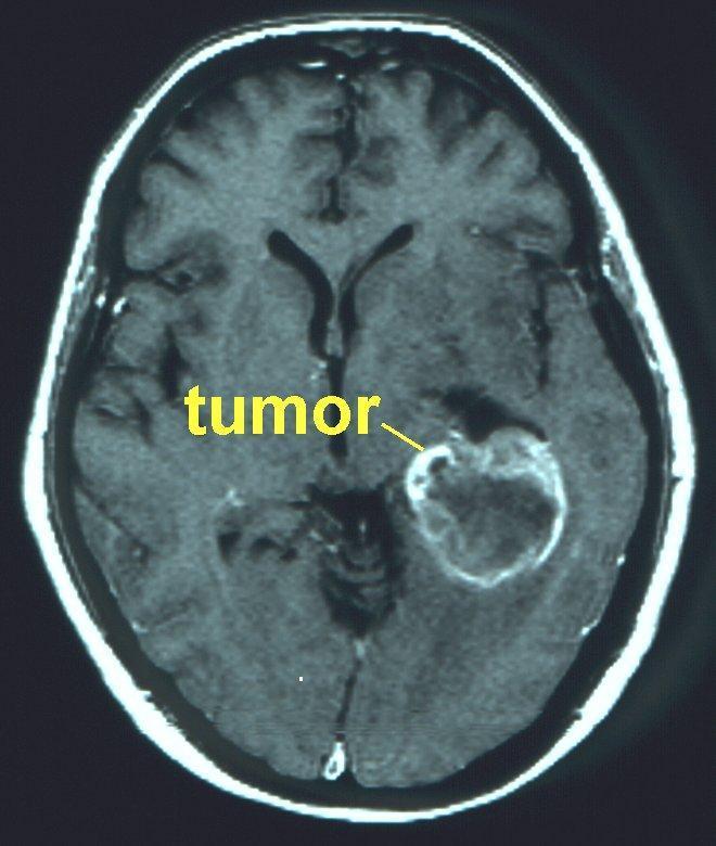 TUMOR Los tumores cerebrales aumentan la masa cerebral, induciendo alteraciones del aporte
