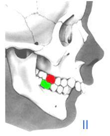 8 Figura 4. Clase II molar Tomado de: http://www.clinicafaus.