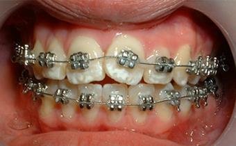 18 Protocolo de tratamiento en dos fases Primera fase se utiliza aparatos de ortopedia funcional en dentición mixta y la segunda fase se utiliza aparatos fijos, cuando se da la erupción de los