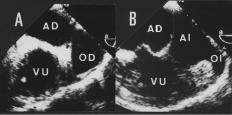 A Fig. 1. Ecocardiograma transesofágico en un paciente con un ventrículo único y yuxtaposición de orejuelas. Cada aurícula se puede identificar por la morfogía de la orejuela.