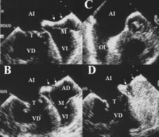 En condiciones normales, la conexión auriculoventricular (AV) es concordante (la aurícula derecha conecta con el ventrículo derecho y la aurícula izquierda con el ventrículo izquierdo), los