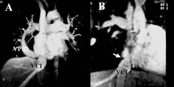 Fig. 4. Resonancia magnética en un paciente con síndrome de la cimitarra. La vena pulmonar inferior derecha (VPID) sigue un trayecto anómalo y se conecta con la vena cava inferior (VCI).