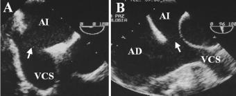 Fig. 5. Ecocardiograma transesofágico en un paciente con CIA tipo seno-venosa.