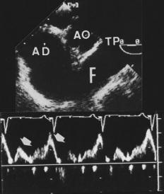 Cuando el parche es grande, la dirección del cortocircuito puede ser muy diversa (interventricular, ventrículo-atrial o aorto-ventricular); no obstante, la mayoría de los casos pueden ser bien