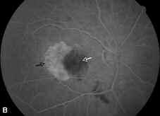 Caso 3 Mujer de 78 años, con antecedentes de fotocoagulación láser por edema macular diabético y drusas blandas en ambos ojos.