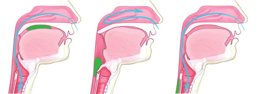 Paladar blando Bolo de comida Lengua Epiglotis Glotis Esfínter superior Ilustración: Brigham and Women s Hospital Figura 1. Fase faríngea de la deglución.