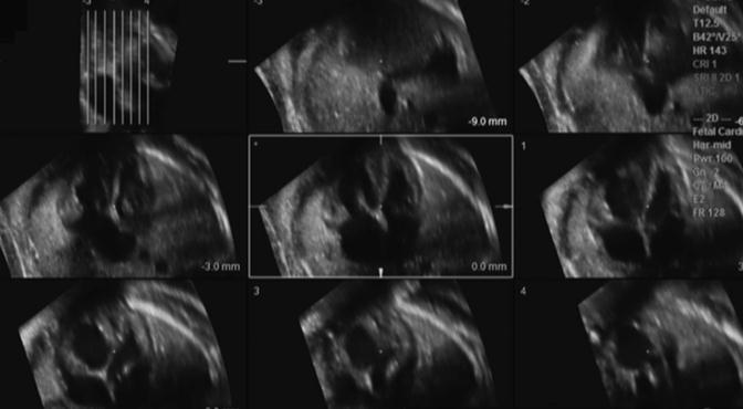 Imagen de ultrasonido tomográfico (TUI) TUI proporciona un análisis secuencial El corazón se puede dividir en planos