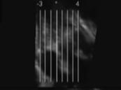 Imagen de ultrasonido tomográfico (TUI) 9 cortes paralelos se muestran simultáneamente desde el plano de interés (el plano cero), dando vistas secuenciales de -4 a +4.
