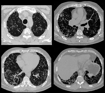 (cuadro 1). En el ecocardiograma transtorácico, se descartaron enfermedad valvular y falla cardiaca. En la gammagrafía ósea se observó captación del trazador en ambos campos pulmonares.