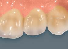 como puede apreciarse especialmente bien en los dientes anteriores VITA MFT: En una combinación óptima con una morfología de aspecto natural y mamelones individuales, la