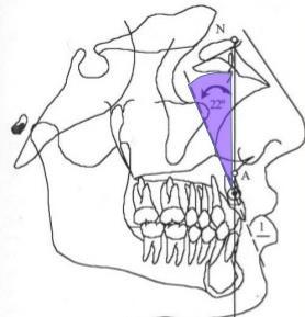 Desviación: 2 Indica la ubicación anteroposterior del maxilar con respecto a la base del cráneo.