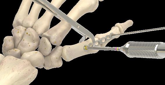 Técnica quirúrgica de fusión de la articulación metacarpofalángica (continuación) 5 Comenzando por el orificio más proximal, perfore con la broca de anclaje rápido de 2,0 mm x 3,5" (80-1796) y la