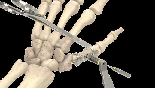 Técnica quirúrgica de la placa gancho para fracturas de Rolando de 1,3 mm 1 Exposición El antebrazo del paciente se coloca en pronación de tal forma que la zona a operar quede expuesta.