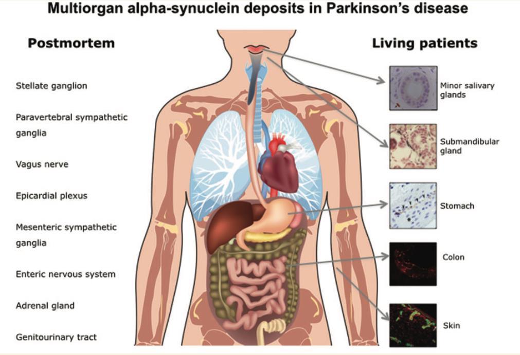 Enfermedad de Parkinson Varios estudios han señalado que muchos de estos síntomas nomotores pueden deberse a depósitos de a- sinucleína en el sistema nervioso