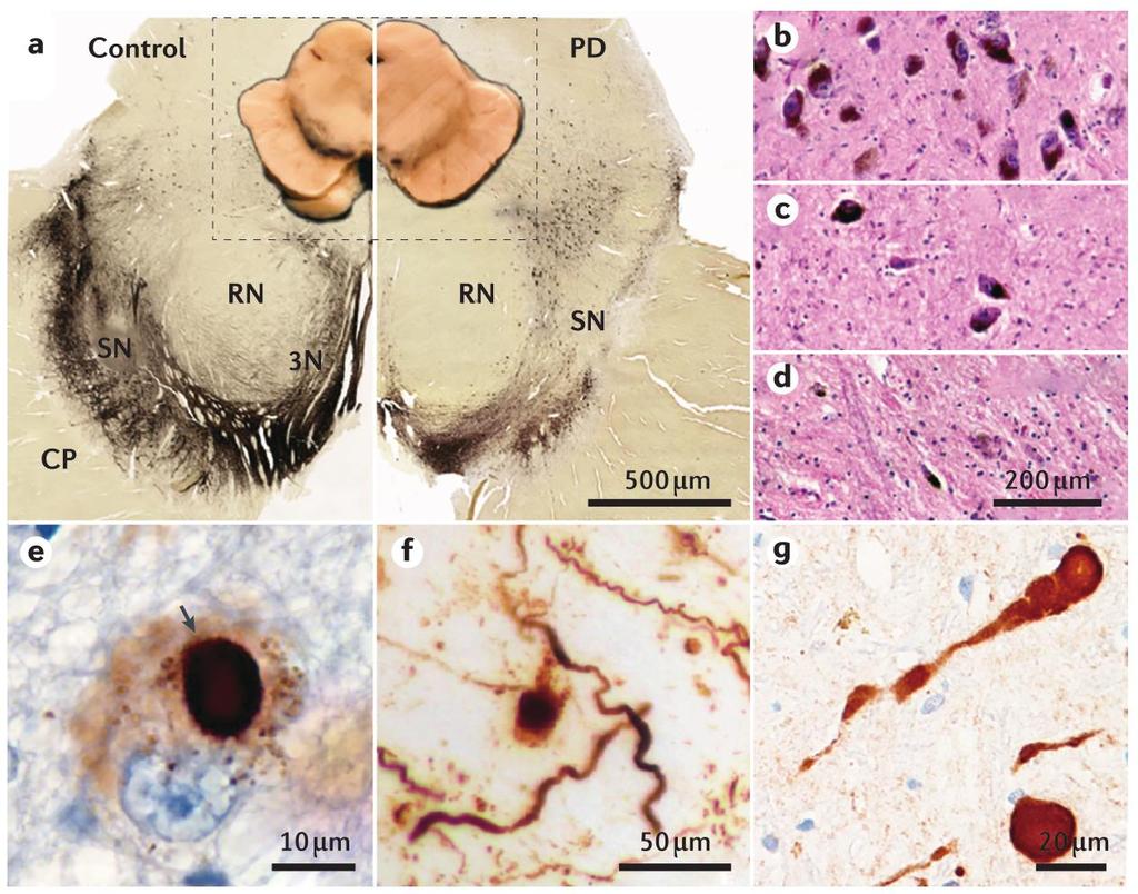Enfermedad de Parkinson Segunda enfermedad neurodegenerativa más frecuente Clínicamente se caracteriza por la presencia de acinesia, rigidez y temblor de reposo Neuropatológicamente se caracteriza