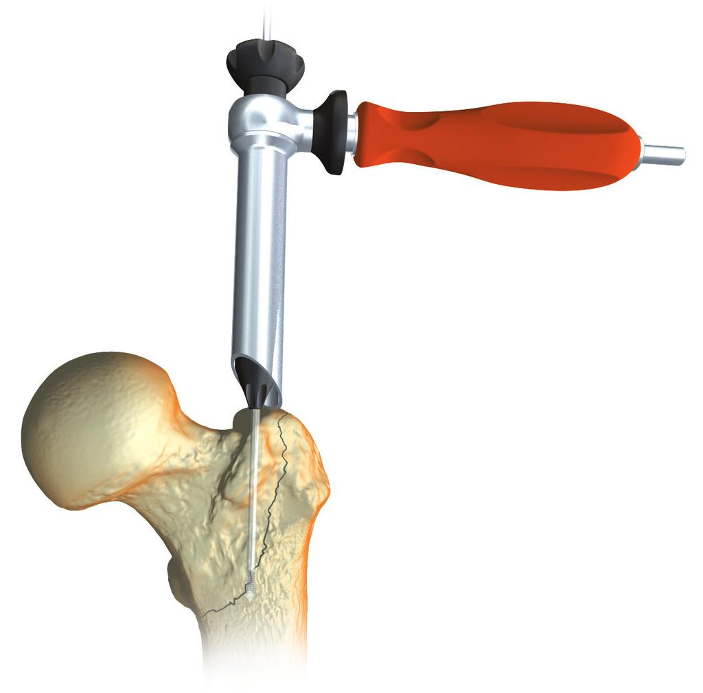 Adquisición de la puerta de entrada Introduzca el instrumento de la puerta de entrada a través de la incisión practicada hasta tocar el hueso.