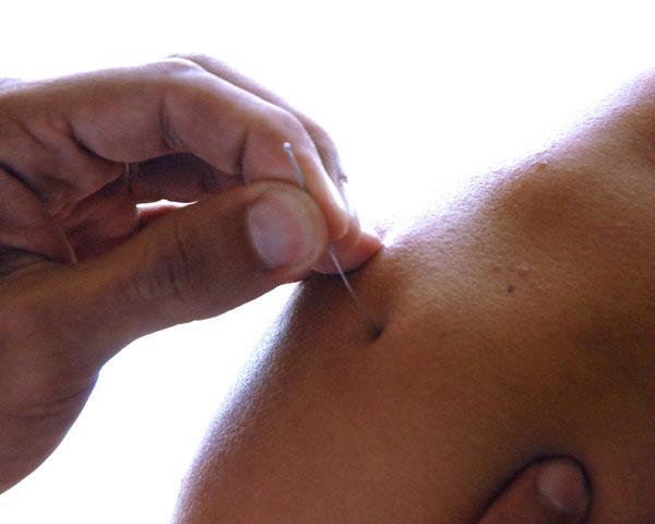 www.juventudrebelde.cu Más del 15 por ciento de las intervenciones quirúrgicas en los centros hospitalarios de las FAR se realiza con analgesia acupuntural.