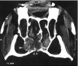 Tomografía computada (TAC): se verifican densidades heterogéneas; la erosión ósea no debe ser interpretada como invasión.
