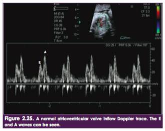En válvulas AV evalúa función diastólica :DISTENSIBILIDAD y CAPACIDAD DE RELAJACION DOPPLER PULSADO / COLOR E/A aumenta progresivamente en el embarazo ( de 0.