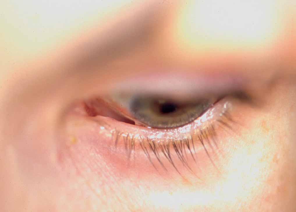 EXPLORACIÓN La exploración del segmento anterior es fundamental para el diagnóstico de las alteraciones de la superficie ocular.
