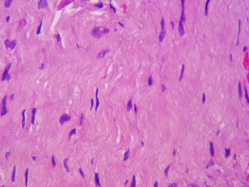 Detalle de las células proliferantes, que mostraban citoplasmas ondulantes