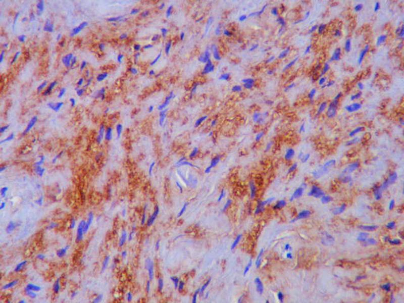 Las células tumorales mostraban inmunotinción para proteína S-100 ( S-100, 200x) Discusión Aunque los carcinomas representan aproximadamente el 99% de los tumores malignos del cérvix, en esta